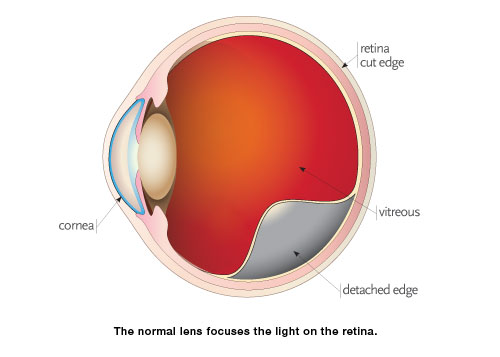 detached retina recovery