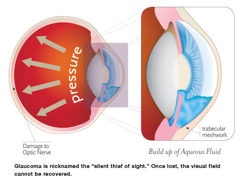 glaucoma treatment